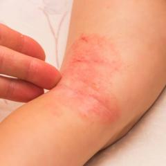 eczema